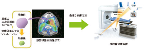 図1　効果予測に基づいた放射線治療